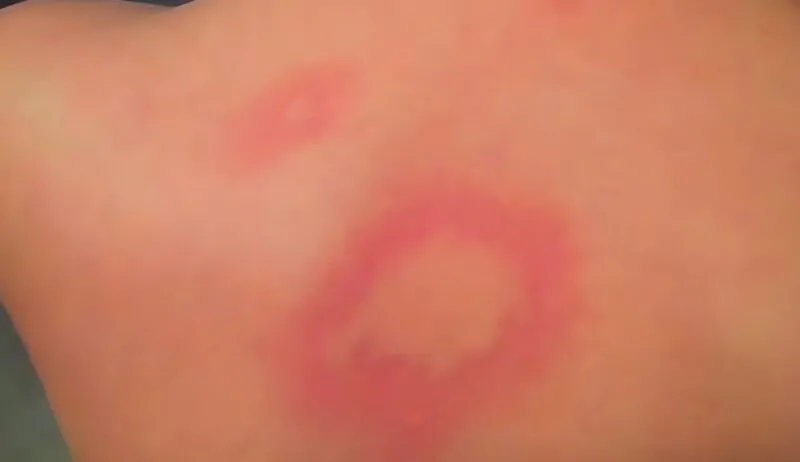 E-cigarette rash indicators