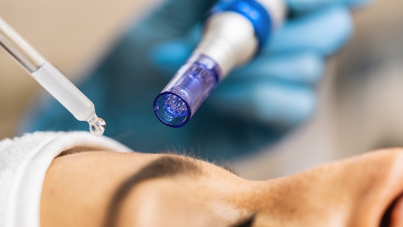 A close-up of a microneedling procedure with serum application
