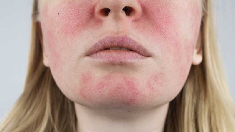 Redness and slight irritation on the skin 48 hours after microneedling treatment