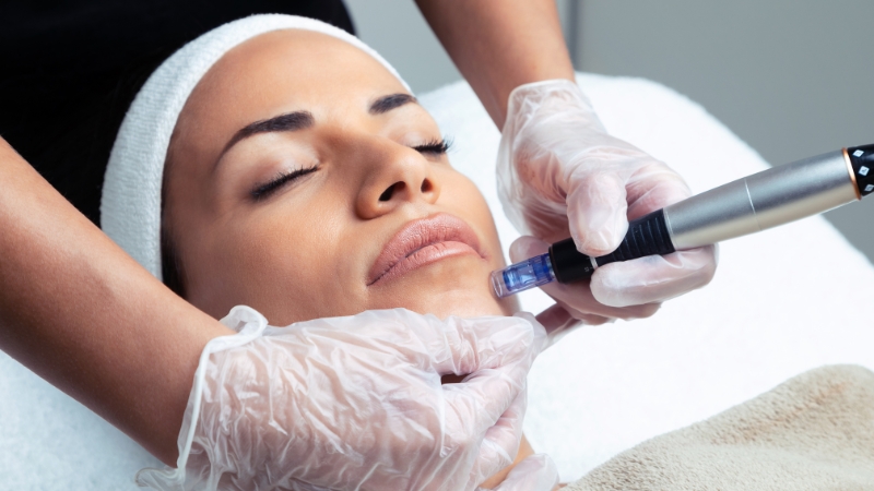 A woman undergoing a microneedling procedure, highlighting the microneedling timeline for skin rejuvenation