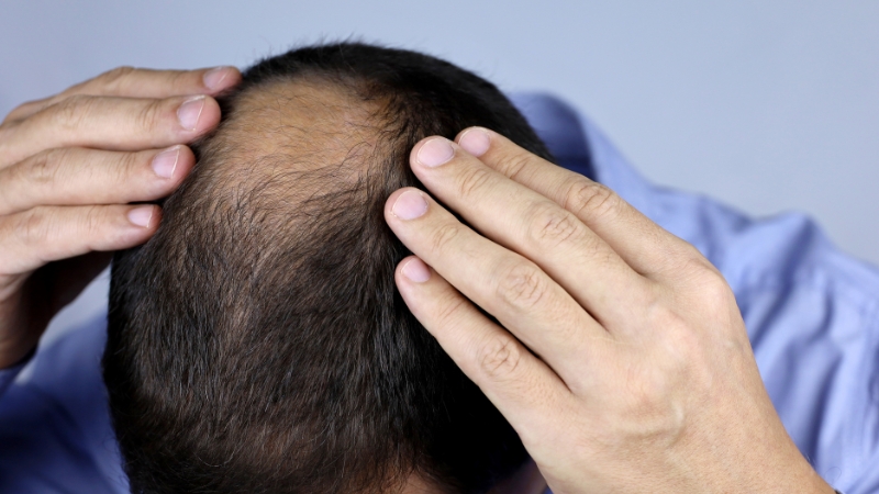 A man with thinning hair checks his scalp with both hands, showing visible signs of hair loss