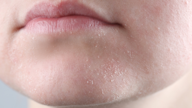 Close-up of dry, flaky skin on the lower face, showing the effects of low estrogen and moisture loss