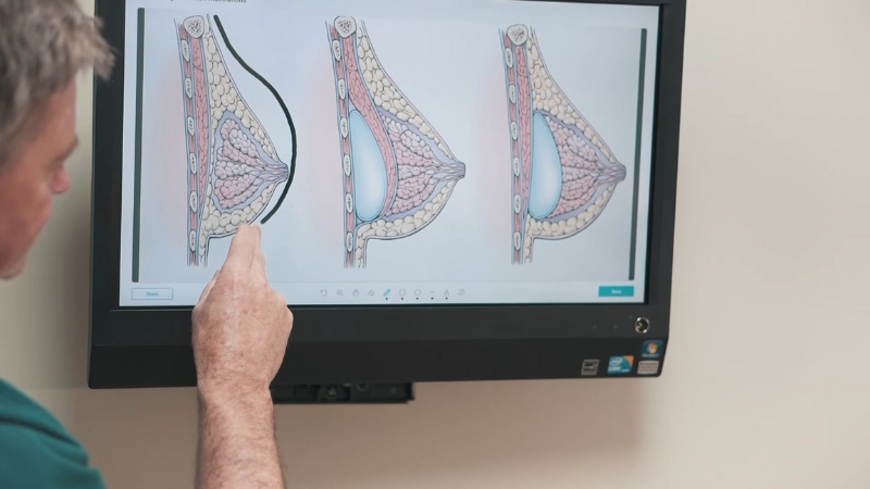A doctor points to breast diagrams showing fat transfer and implant options