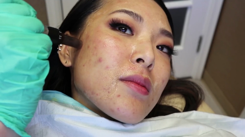 A woman receives PRP microneedling treatment to improve skin texture and reduce acne scars