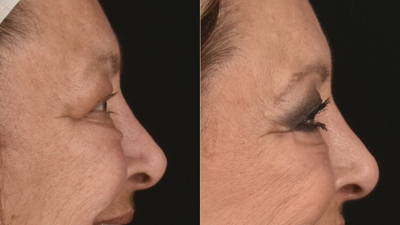 Before and after comparison of a woman’s under-eye area showing smoother skin after blepharoplasty