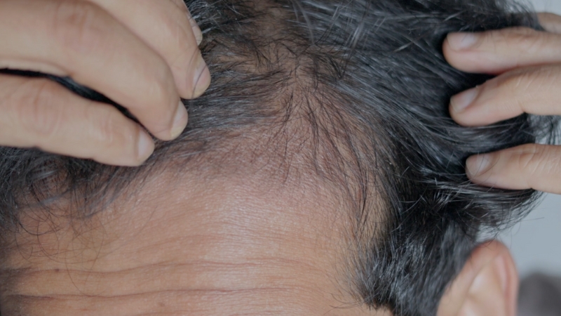 Close-up of a man parting his hair to show thinning at the front of his scalp